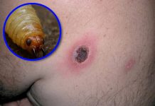 Confirman 15 casos de miasis por gusano barrenador en humanos en Chiapas