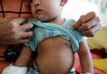 Detectan primer caso importado de sarampión en Chiapas; activan cerco sanitario